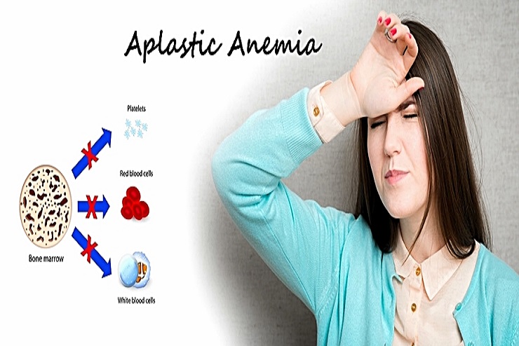 Jangan Menyerah! Ini 5 Cara Atasi Anemia Aplastik