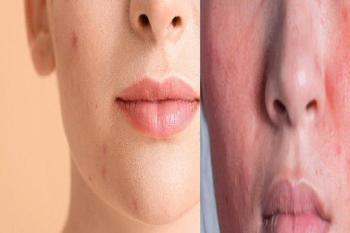 Kenali Beberapa Tanda Skin Barrier Rusak