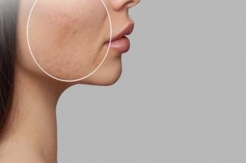 Penyebab Bopeng yang Bikin Tak Percaya Diri Serta Cara Mengatasinya